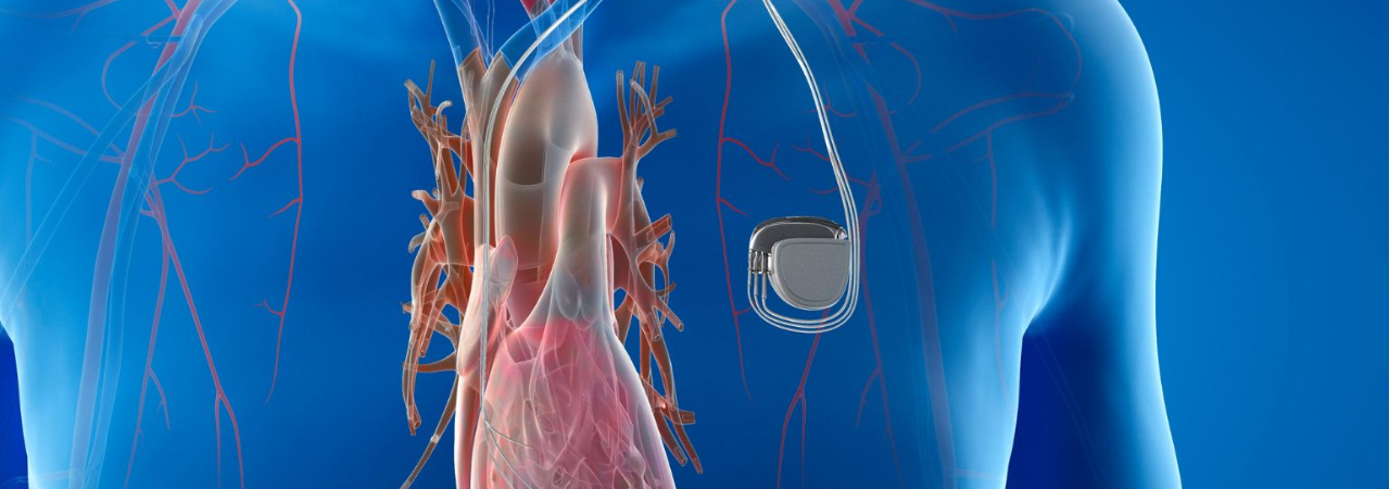 Pacemaker programozás