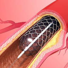 Túl a sztentelésen? Előzze meg a koszorúér újabb elzáródását