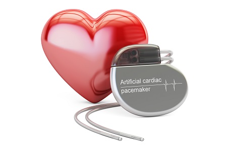 A pacemaker beültetés után szükséges a rendszeres kardiológiai ellenőrzés.