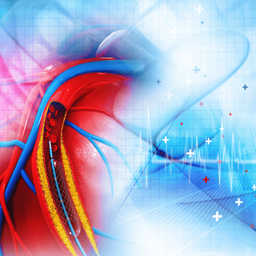 Stent beültetése - Kardioközpont